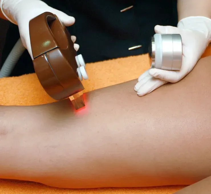 depilacja laserowa w Poznaniu